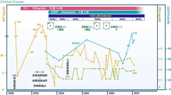 日本免疫細胞治療(瀨田診所)：胃癌，女，62歲