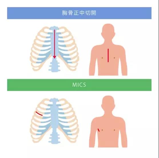 MICS(微創(chuàng)心臟手術(shù))