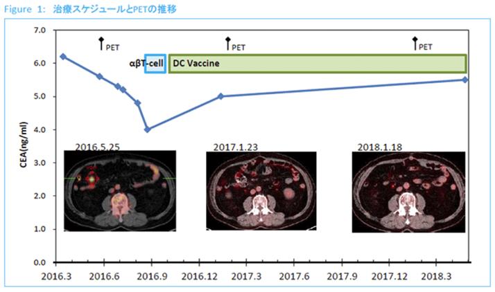 癌癥免疫細胞療法之復發結直腸癌