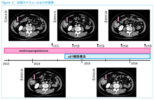 子宮內膜癌使用免疫細胞治療效果如何？