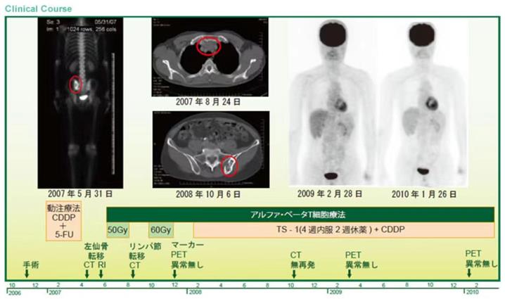 細胞免疫療法之惡性黑色素瘤