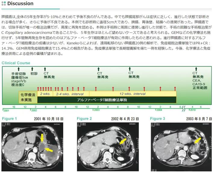 細胞免疫療法之胰腺癌